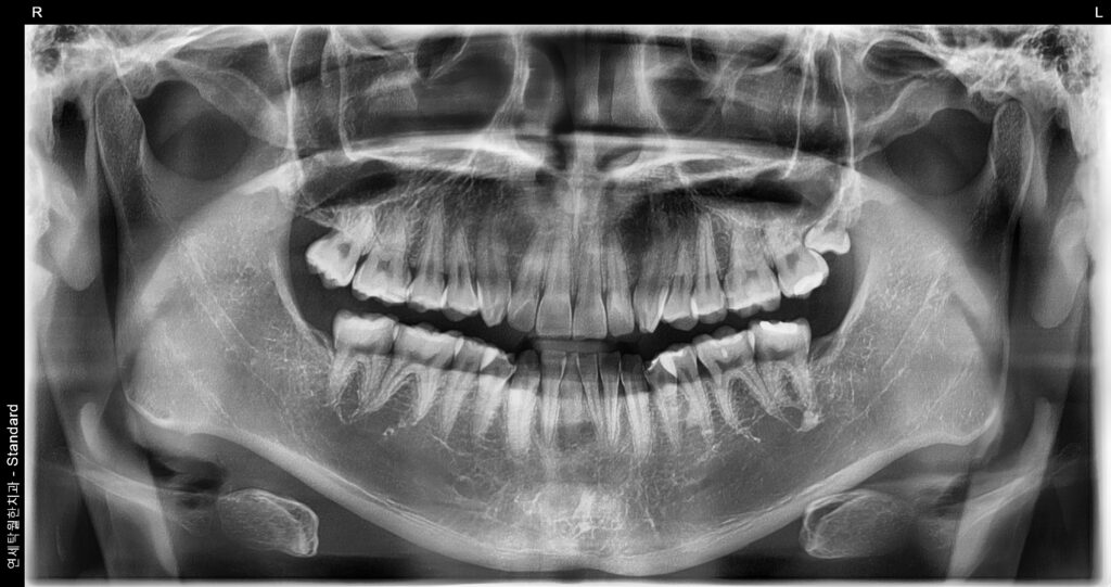 상악 매목 사랑니
